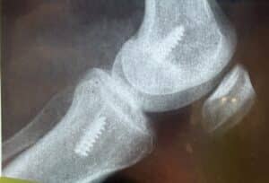 Nicola Ellis ACL Repair